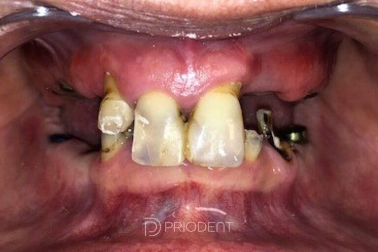 Tandimplantat_Förebild