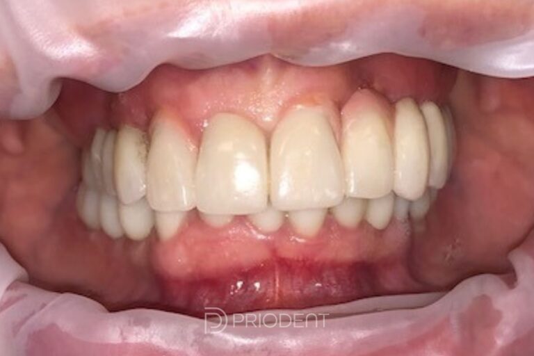 Tandimplantat_Efterbild