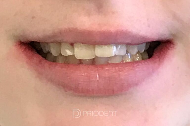 Innan behandling med aligner