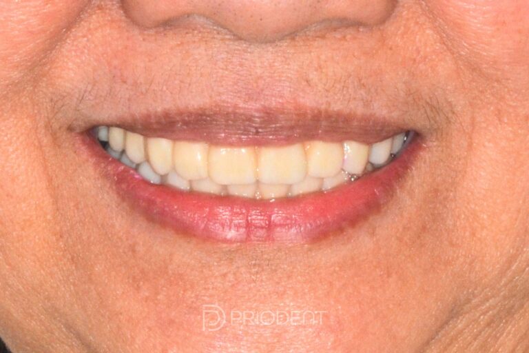 Pat8126 _efter tandimplantat