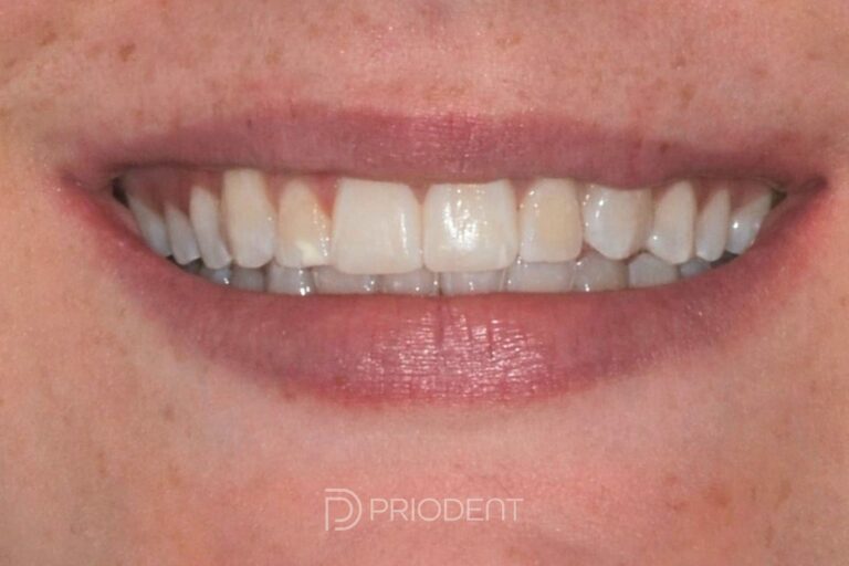 Efter behandling med aligner