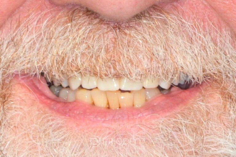 Tänder efter tandimplantat
